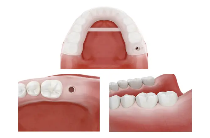 イメージ：当院のインプラントシステム1