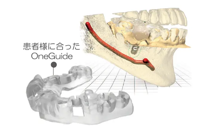 イメージ：当院のインプラントシステム2