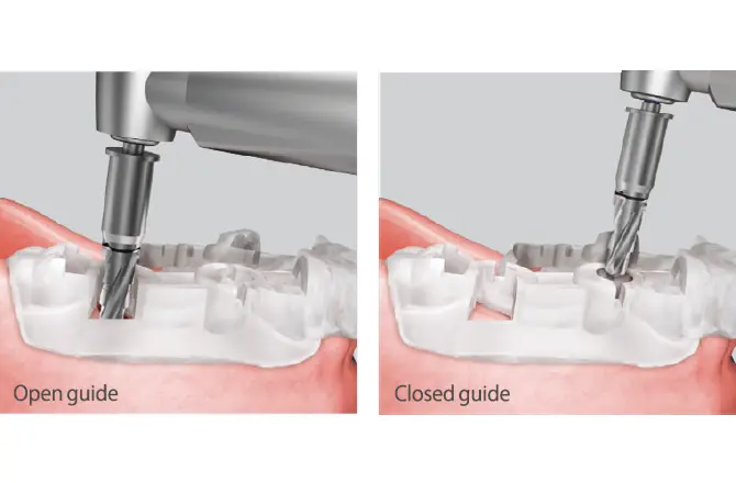 イメージ：当院のインプラントシステム3