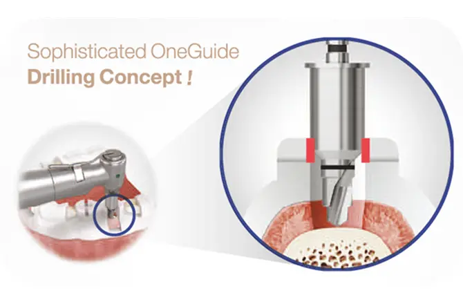 イメージ：当院のインプラントシステム4