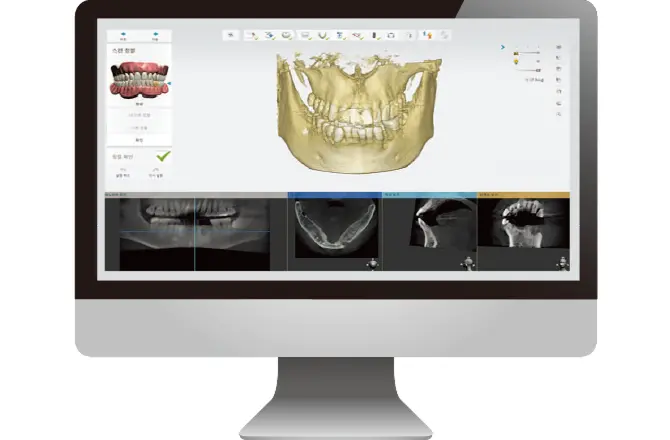 イメージ：当院のインプラントシステム5