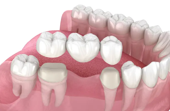 イメージ：インプラントで解決できること3