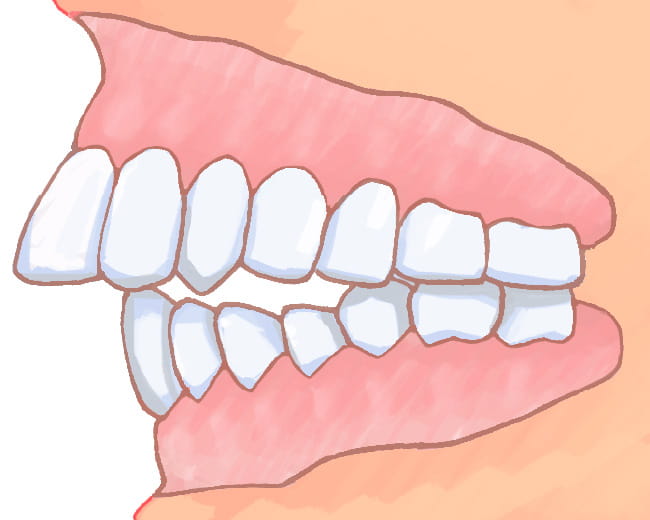 イラスト：上顎前突