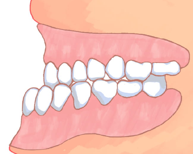 イラスト：下顎前突・反対咬合