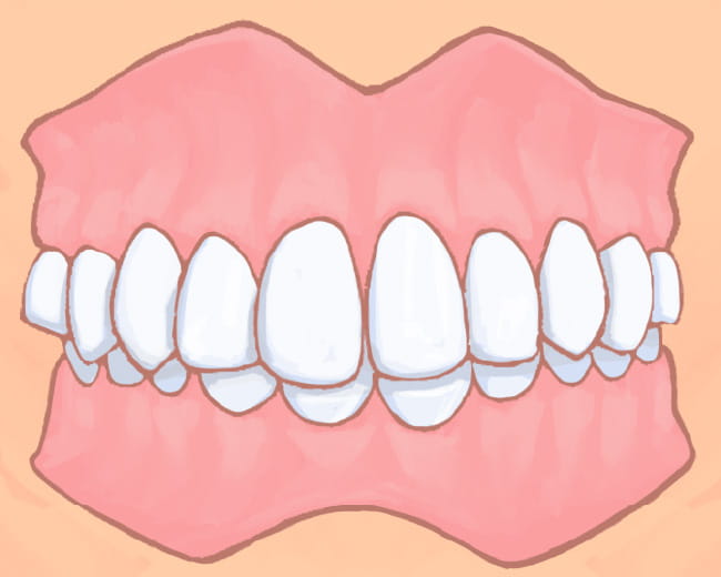 イラスト：過蓋咬合
