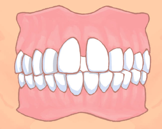 イラスト：空隙歯列